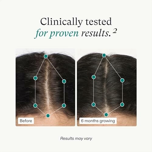 Comparison of hair growth before and after 6 months.